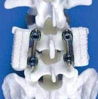 medtronics Amplify, a product used in spinal surgery, that act as carriers for bone morphogenetic protein-2 as well as a scaffold for new bone formation.