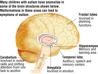 autistic-brain