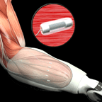 Artist's concept of Leaded Implantable Myoelectric Sensors (LIMES) to be used as a novel peripheral-interface technology with targeted muscle re-innervation (TMR)