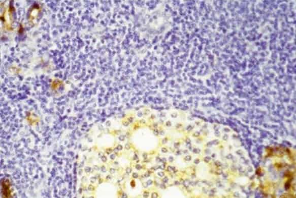 Dead and dying metastatic prostate cancer cells (round light-colored area) inside a lymph node, surrounded by purple-stained lymphocytes of the immune system. Upper left and lower right corners: degenerating metastatic cells that still make prostate-specific antigen (PSA), which stains brown.  (c) University of Minnesota 