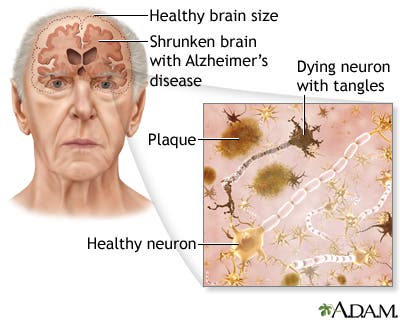 Effects of Alzheimer's. Image: healthbenefitstimes.com