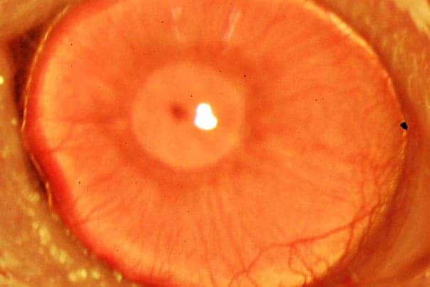 restored_cornea