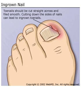ingrown_toenail