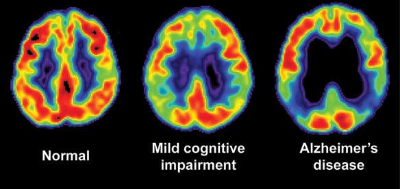 Alzheimer’s disease is progressive in nature, meaning that it is not reversible, and it eventually leads to death. Every case of AD is different but the ultimate path of the disease is somewhat predictable and occurs slowly over the course of 2-20 years. It generally starts with deterioration in the Hippocampus, an inner structure of the brain associated with memory and learning. The disease then tends to spread from front to back of the cerebral cortex, until reaching the brain stem, where involuntary functions such as breathing, heart rate and blood pressure are regulated. Image: Wikimedia Commons