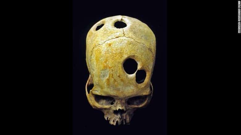 Ancient Inca surgeons carefully made perfect holes in the skulls of their patients. Some would survive, but why they had to make this many is a mystery. 