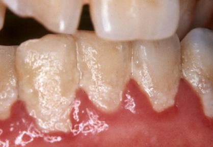 Biofilm on teeth, commonly known as dental plaque. Credit: Mead Family Dental.