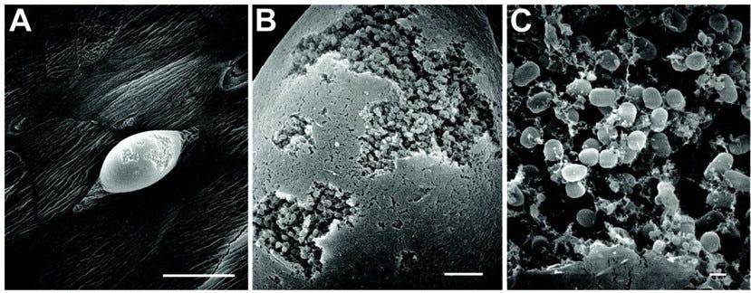 Scanning electron images of the surface of a mouse bladder infected with urinary tract infection show large intracellular communities of biofilm bacteria inside pods. Uninfected bladders appeared smooth, but infected bladders had bumps all over them. Credit: The Marshall Protocol Knowledge Base.