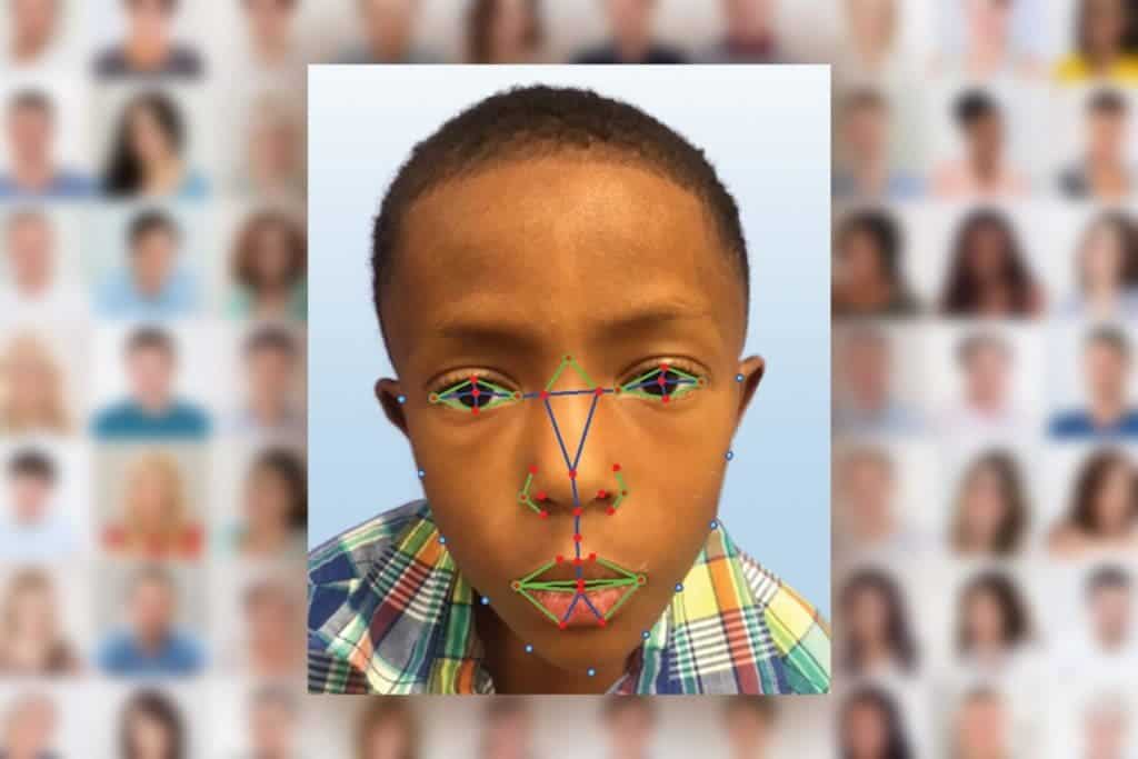 How the software analyzes physical traits to for a possible diagnosis with DiGeorge syndrome, a rare disease. Credit: Paul Kruszka, et al.