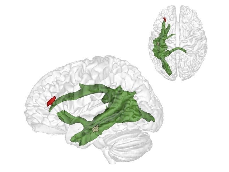 Maturation of fibers in the arcuate fascicle (green) establishes a connection between two critical brain region enabling the 'theory of mind'. Credit: MPI CBS