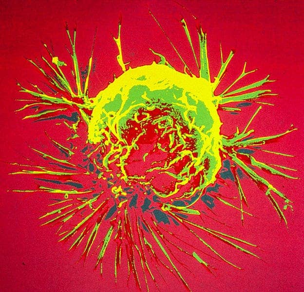 Breast cancer cell.