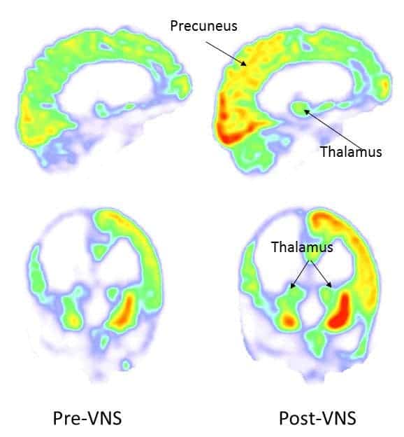 After vagus nerve stimulation, the metabolism increased in the right parieto-occipital cortex, thalamus and striatum. Credit: Corazzol et al.