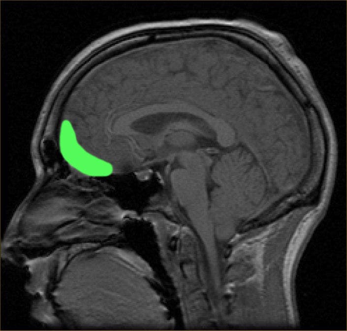 MRI orbitofrontal cortex.