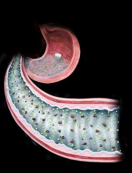 Illustration of the new pill developed at BWH that mimics the effects of gastric bypass surgery. Credit: Brigham and Women's Hospital and Randal Mckenzie.