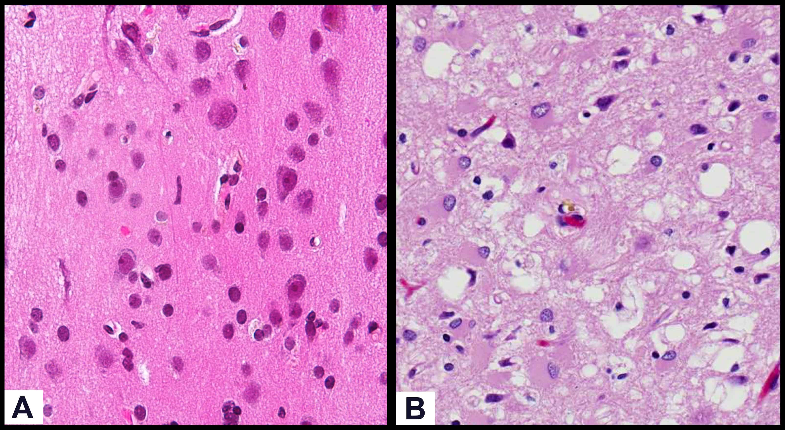 What are prions -- the confusing protein
