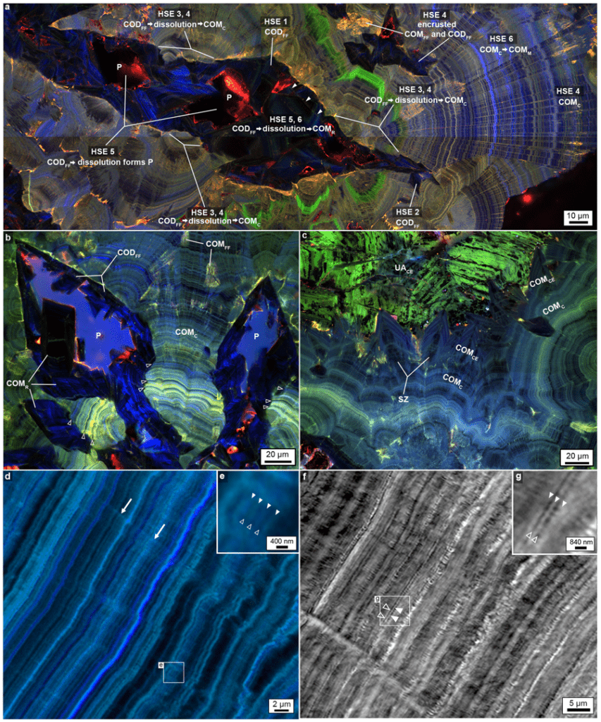 Kidney stones microscopy.