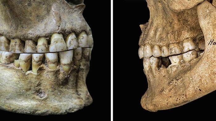 Edge-to-edge overbite of ancient hunter-gatherer woman (left) vs overbite configuration seen in Bronze age male (right). Credit: Science.